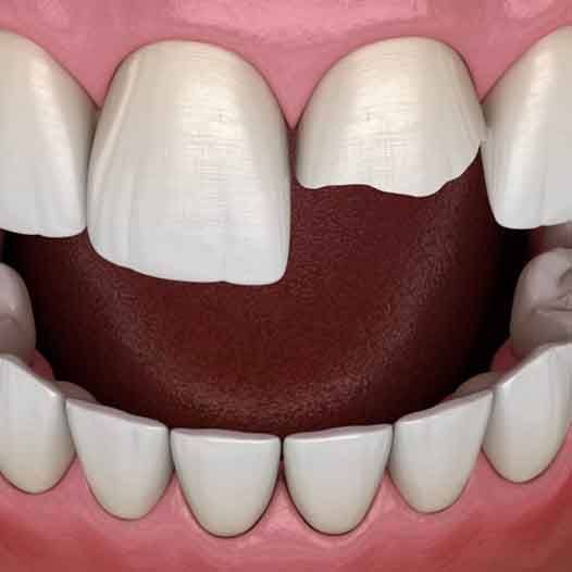 Model of chipped front tooth