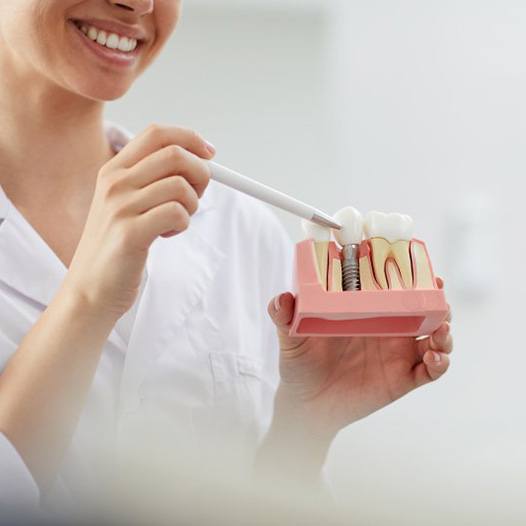 a dentist showing a model of dental implants