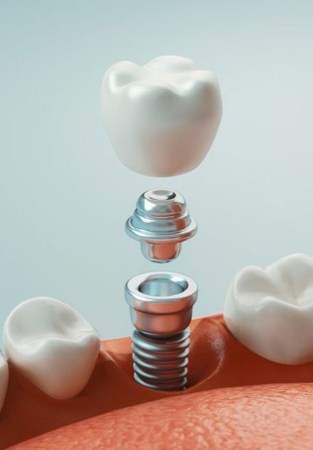 a 3D illustration of a dental implant