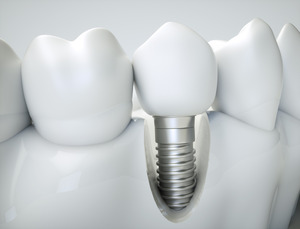 Illustration of dental implant in jawbone