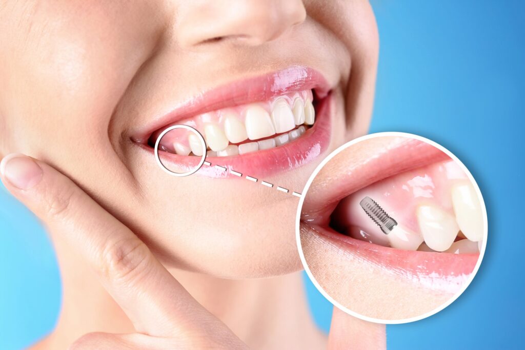 Nose-to-neck view of woman smiling with one tooth indicated as an implant 